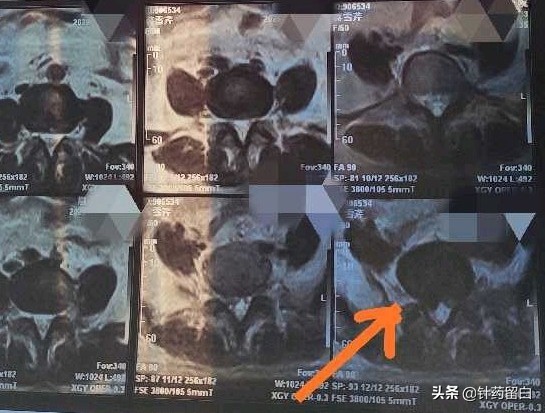 一文读懂靶向治疗,一文看懂椎体成形