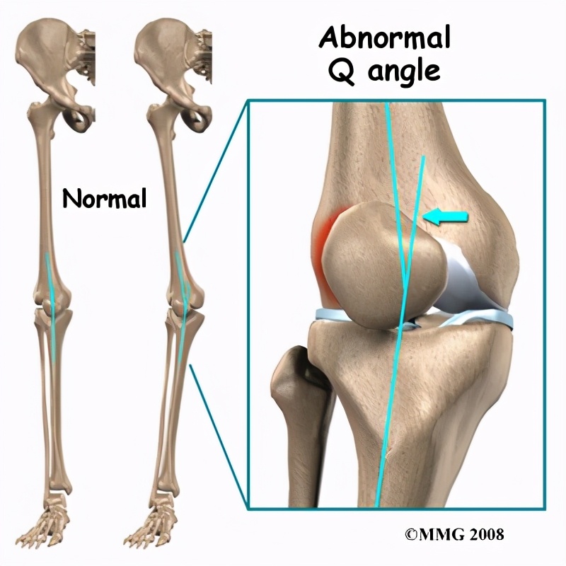 膝髌骨下方疼痛如何治,膝髌骨痛是什么原因引起的