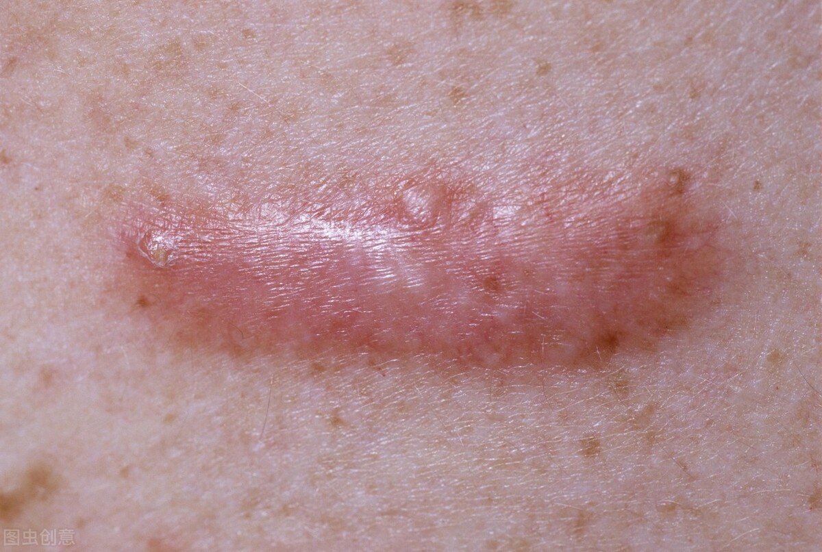 疤痕疙瘩发痒怎么治疗,陈旧疤痕突然变红发痒