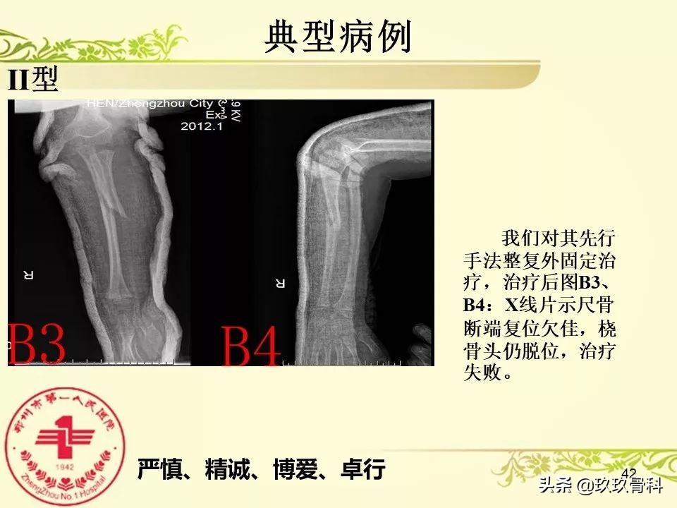 孟氏骨折功能训练多久能恢复正常,孟氏骨折中医能治吗