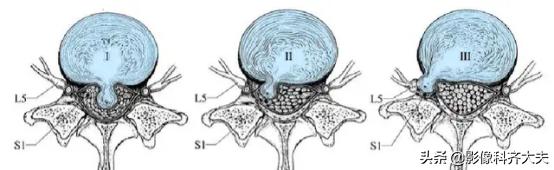腰椎间盘突出是什么,腰椎间盘突出和腰间盘突出有区别吗