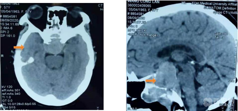 恶性脑瘤切除手术成功率,脑部肿瘤鼻腔微创手术