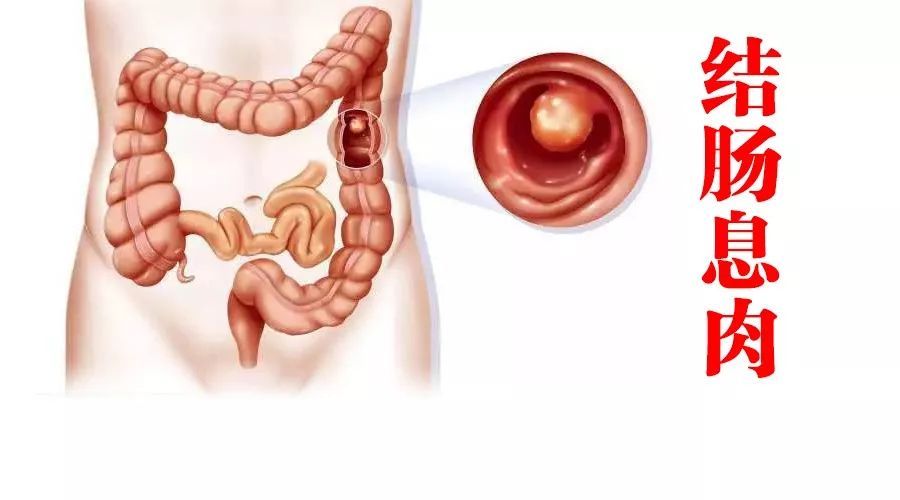 黑斑息肉综合征有什么症状,黑斑息肉综合征临床表现