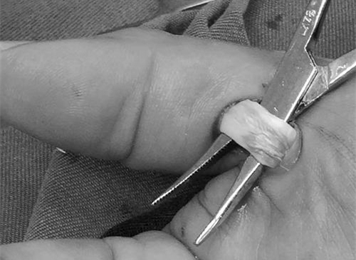 手指狭窄性腱鞘炎最快的恢复办法,手指狭窄性腱鞘炎怎么治疗小视频