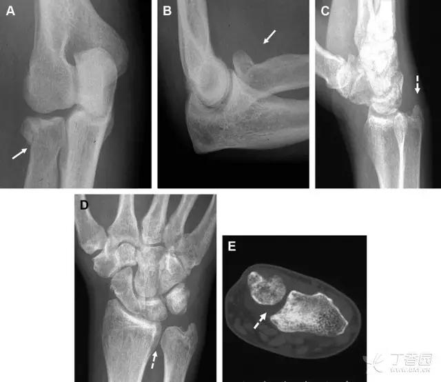 几种严重骨折医学名称,常见的骨折有哪些名称