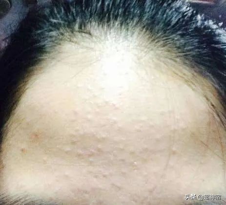 教你5个根治闭口粉刺方法,闭口痘痘彻底根治