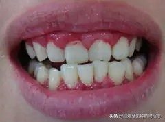 牙缝大是福是祸,牙缝宽什么命运