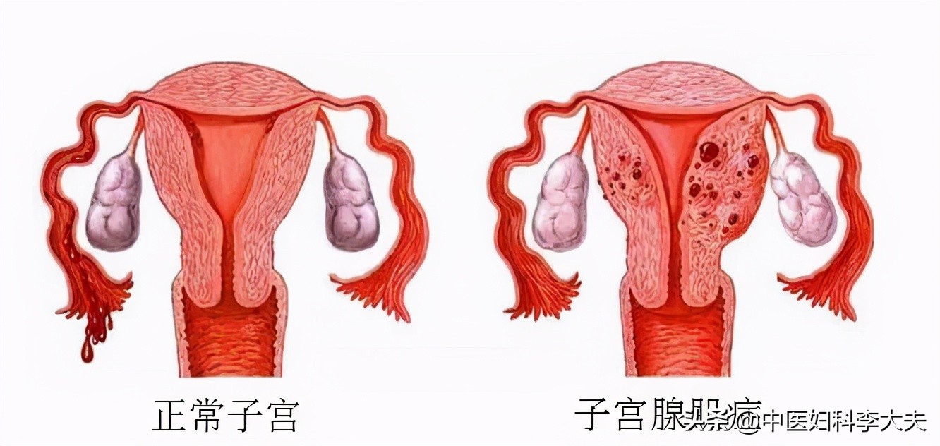 子宫腺肌症子宫增大怎么办,子宫增大是什么原因引起的
