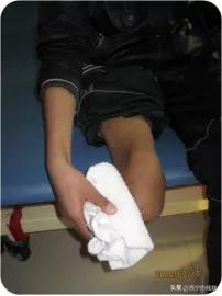 简单的截肢方法,截肢物理治疗