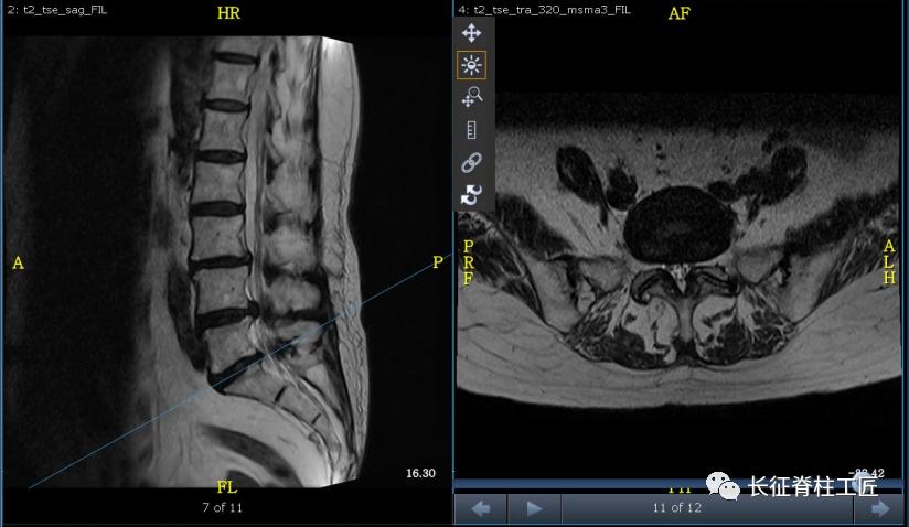 老年人腰椎管狭窄可以微创手术吗,老年人腰椎管狭窄瘫痪