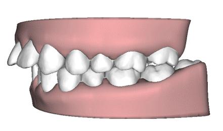 如何理性看待牙齿正畸,齿性偏颌矫正案例