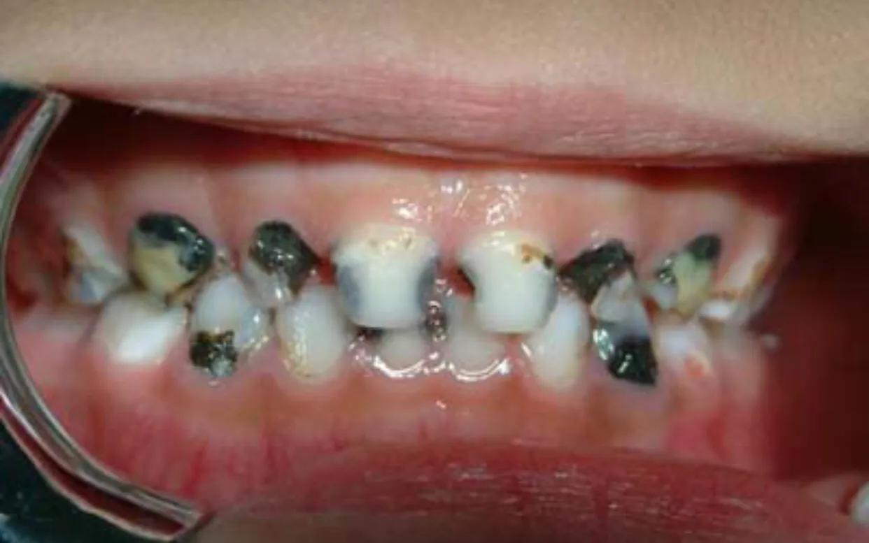 真正超声波牙刷洁牙器,超声波洁牙器是智商税吗