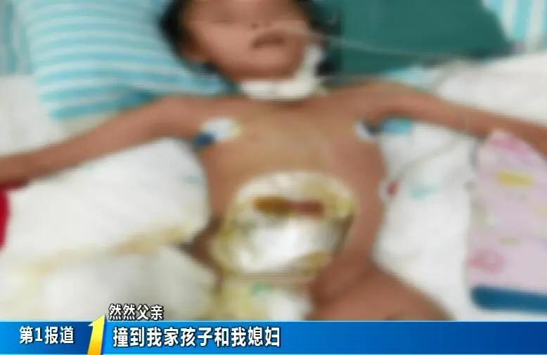 新闻追踪：9岁女孩然然今天经历首场皮肤修复手术