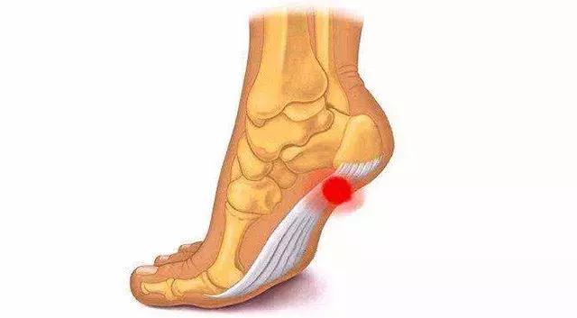 足底筋膜炎最怕的克星是什么,足底筋膜炎最怕的克星