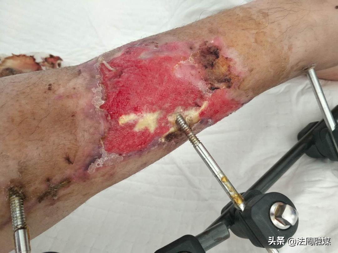 交通事故小腿胫骨骨折做手术,常德市第一中医医院骨伤科