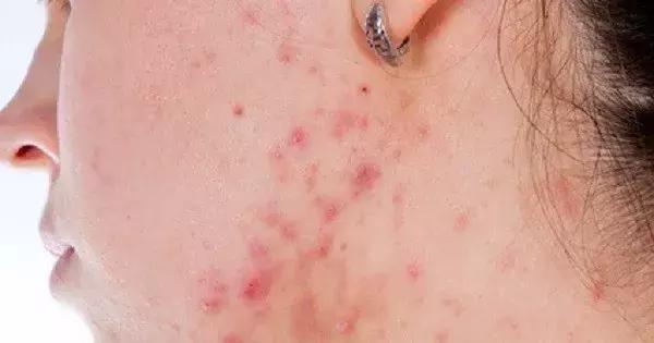 怎样改善油性皮肤问题,怎样改善油性皮肤长痘