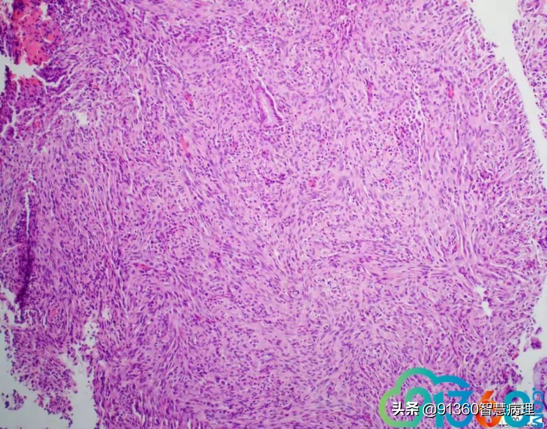 宫颈腺癌silvaa型用化疗吗,宫颈腺癌silvab型需要放疗几次