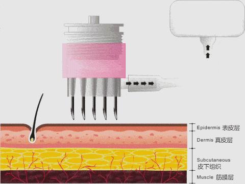 水光针在脸上扎多少下,微针在脸上扎多少针