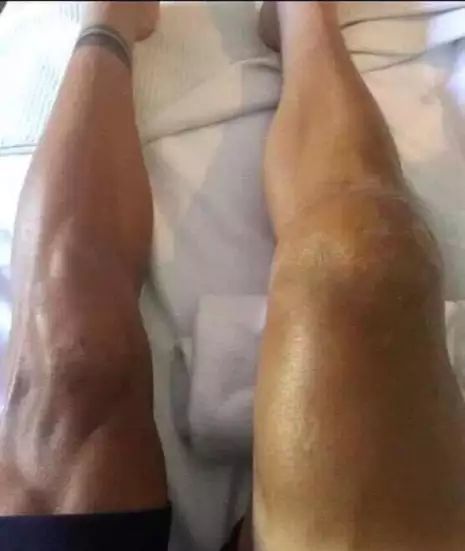 acl受伤视频,acl受伤视频集锦