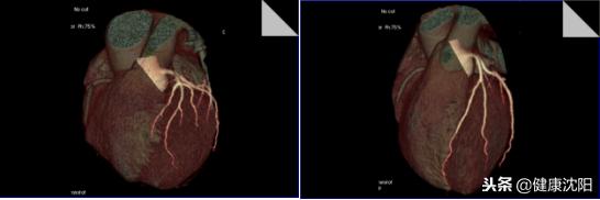 cta和血管造影怎么选择,血管oct检查与血管造影检查的区别
