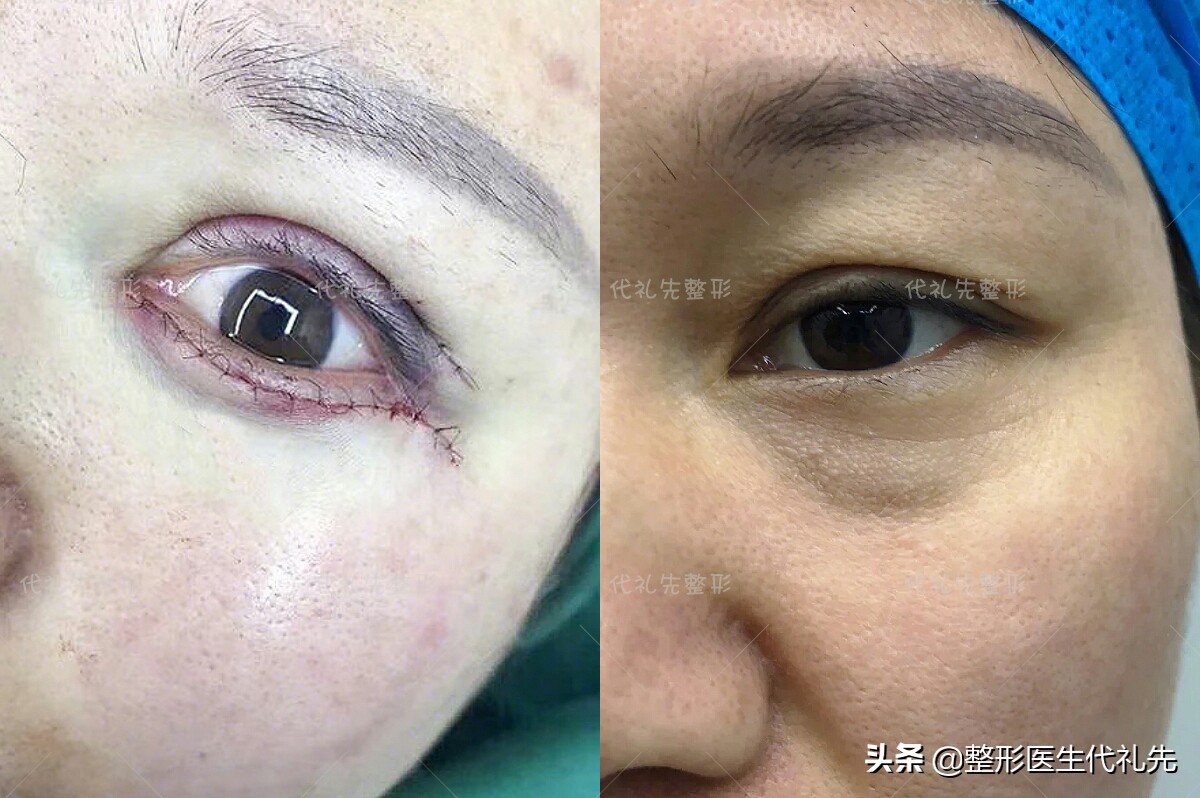 问一下有什么方法快速消除眼袋,关于眼袋的去除方法