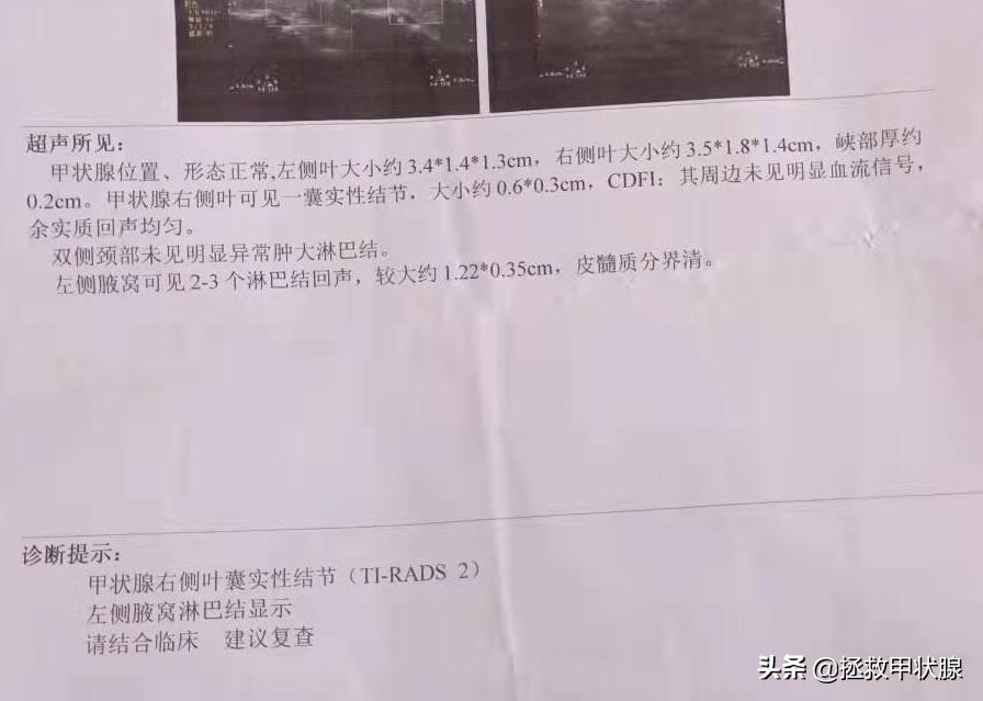 甲状腺结节3级服中药有散结的吗,甲状腺结节淋巴结节吃药能好吗