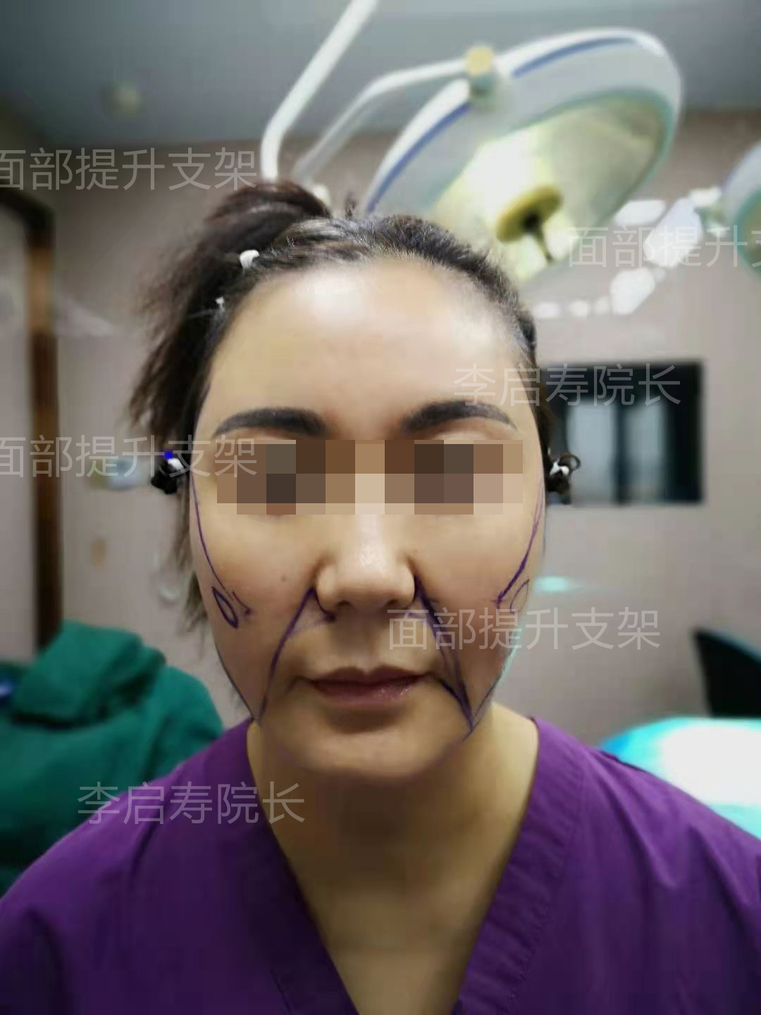 40岁做了线雕的前后图片,40岁以上法令纹下垂医美