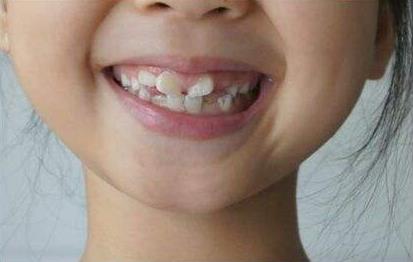 孩子换牙期怎么防止牙齿不齐,宝宝换牙期父母注意7大问题