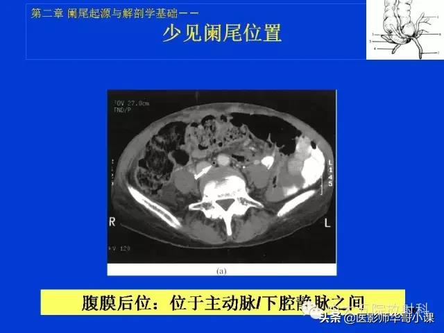 阑尾炎课件,阑尾炎的超声课件
