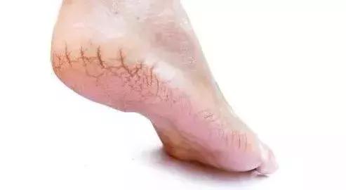 为啥脚后跟干裂起鱼鳞皮,脚后跟干裂小腿长鱼鳞