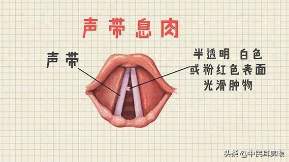 声带息肉健康宣教教程,声带息肉的科普视频