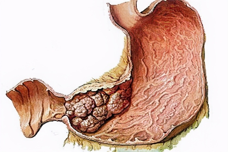 抗生素可以治疗孩子淋巴瘤吗,淋巴瘤输抗生素能缩小是良性吗