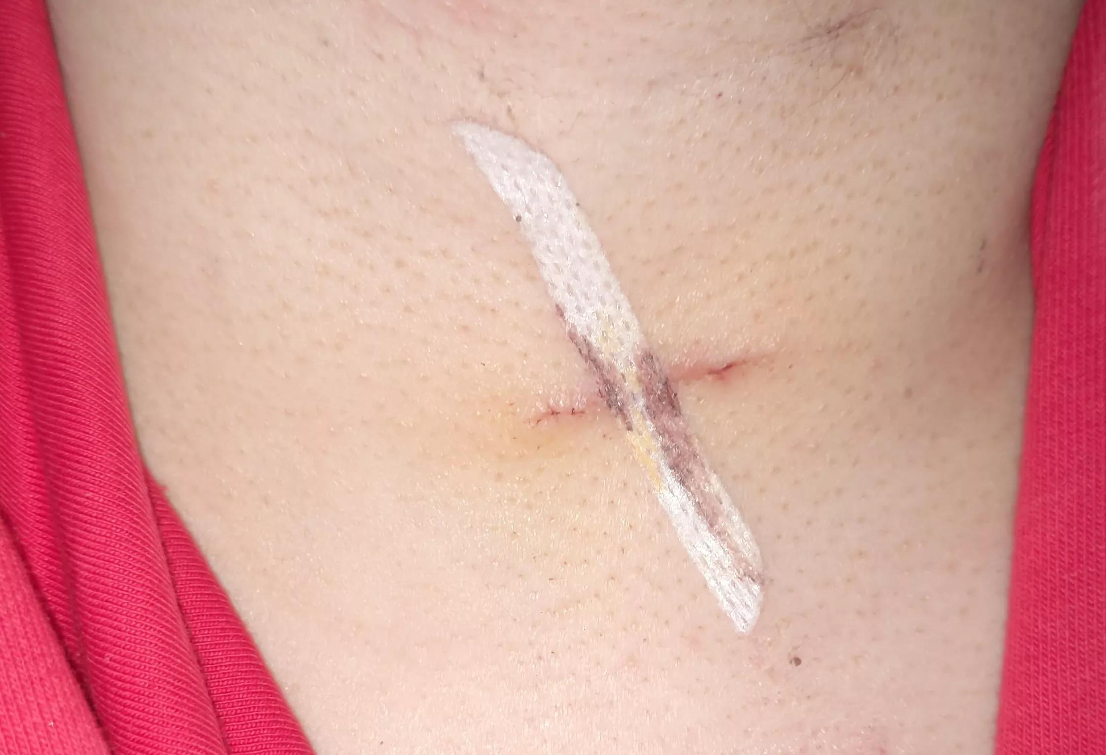 伤口美容缝合跟普通缝合比较图,皮肤缝合的手法