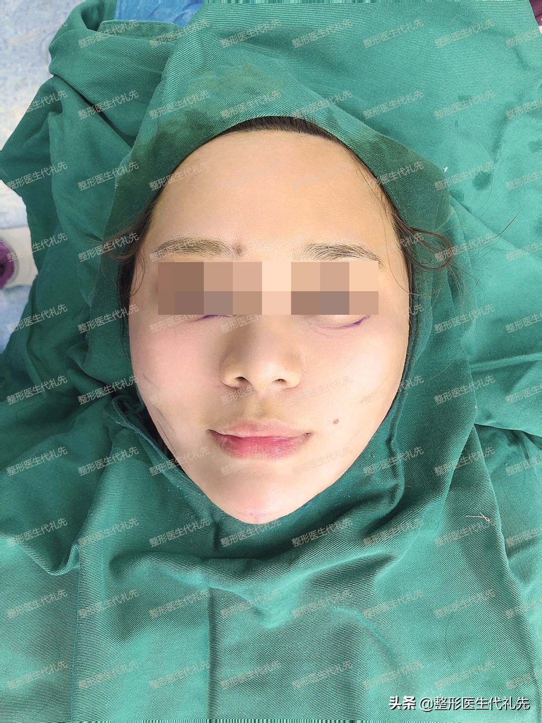 做微创过程,超微创小切口面部提升维持多久