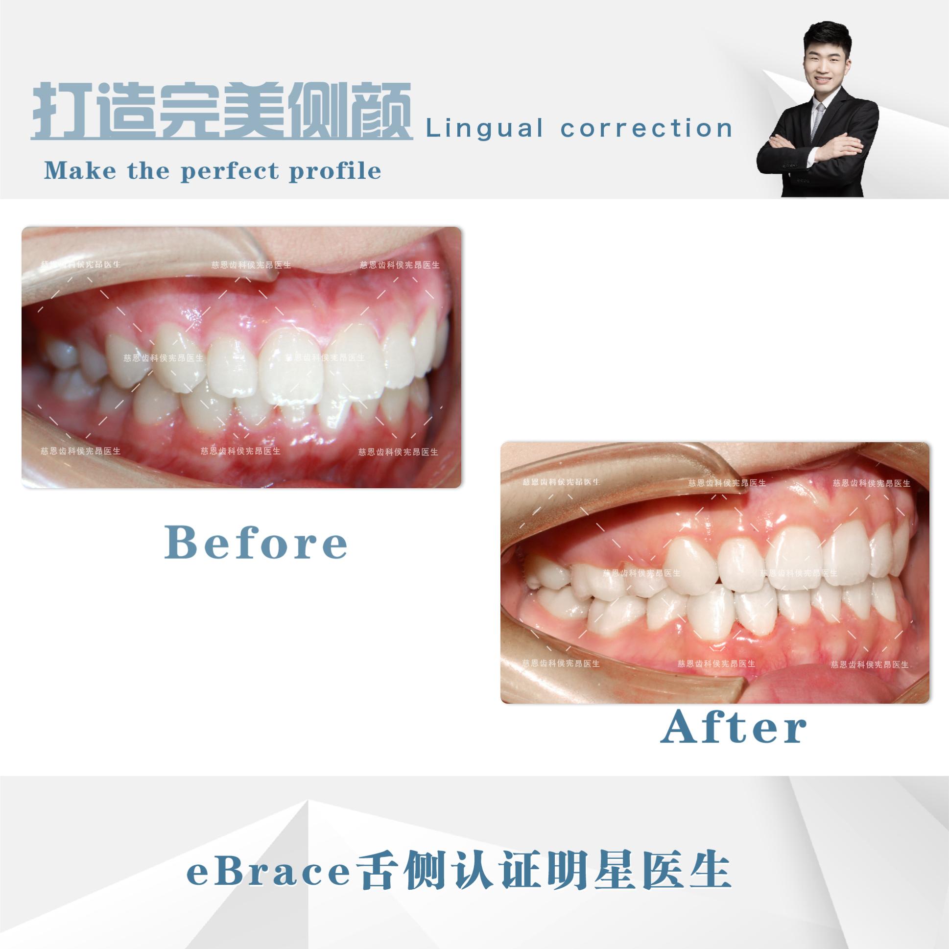 牙突怎么矫正,怎么矫正嘴突