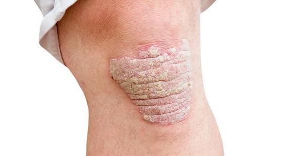 惹上牛皮癣这个大佬，脱发也来敲你的门？