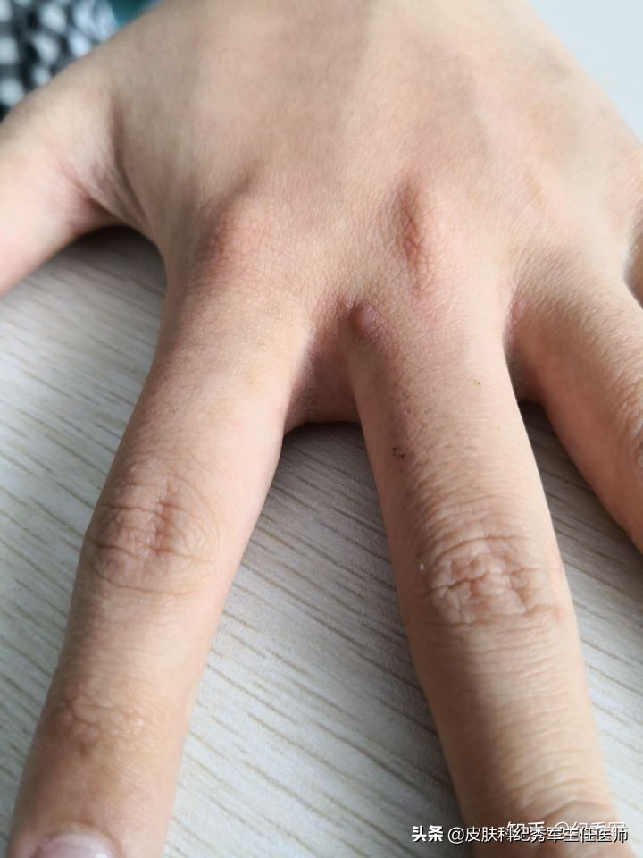 疥疮具有诊断意义,疥疮在临床上如何确诊