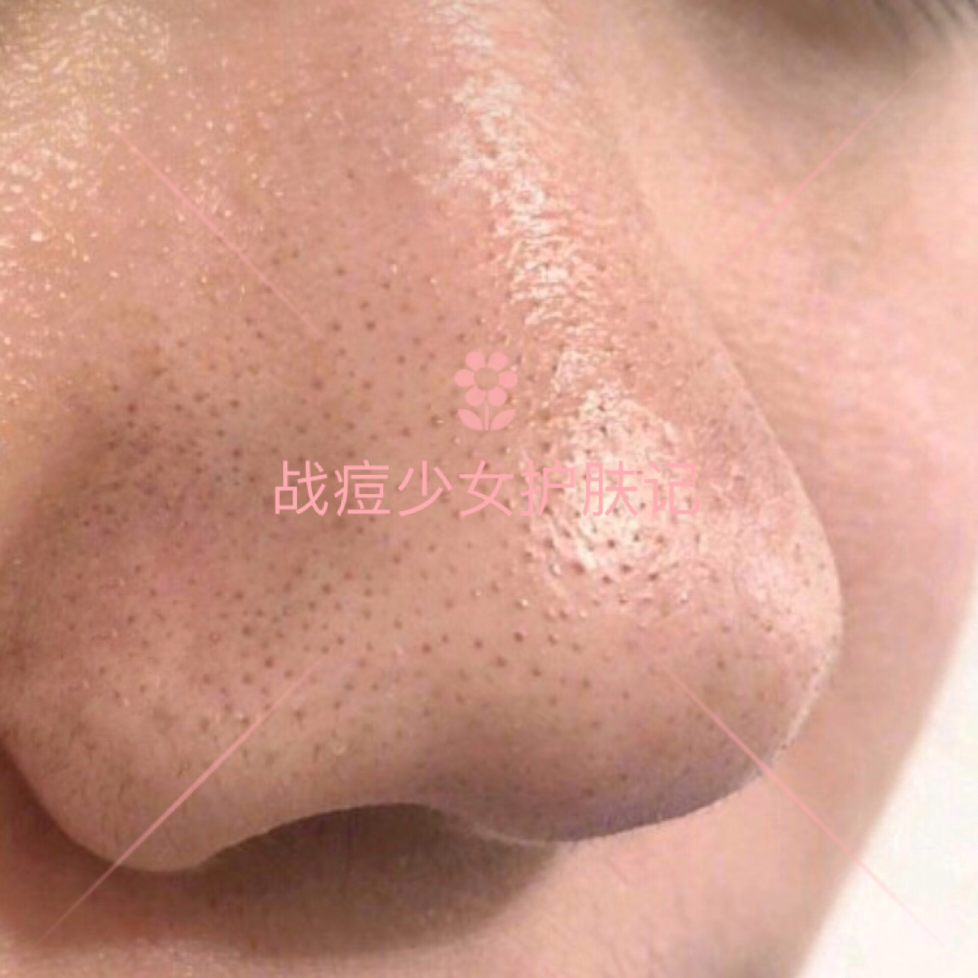 各种类型的痘痘怎么祛痘,痘痘六种类型上集