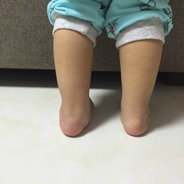 2岁小孩膝外翻怎么治,孩子有一点点足外翻怎么矫正