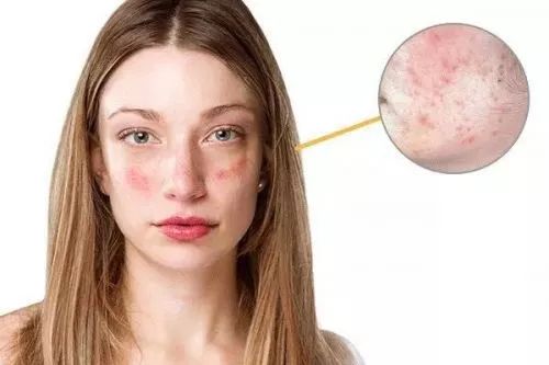 长痘痘为什么会发痒？长痘皮肤发痒该怎么办呢？