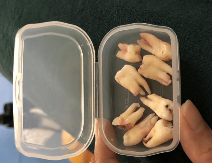 牙套隐形日记,牙套日记正颌