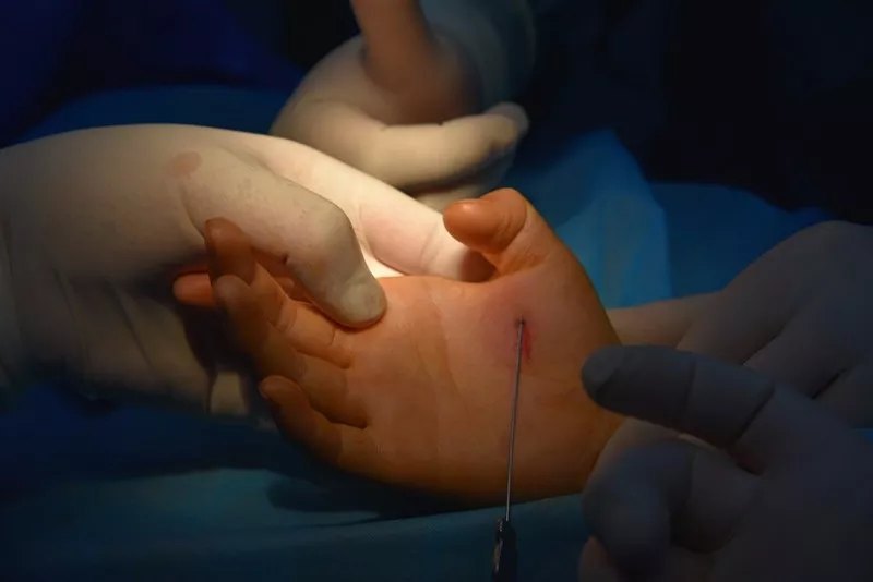 扳机指如何治疗,扳机指要怎么治疗