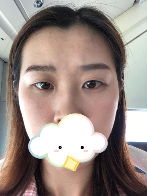 修志夫做双眼皮效果怎么样,修志夫双眼皮修复