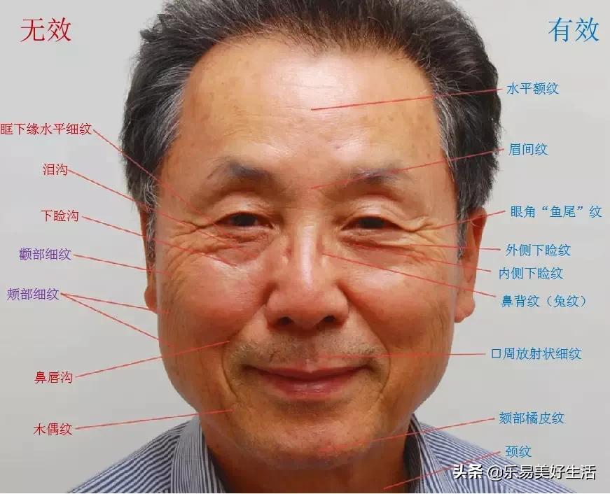 肉毒毒素注射美容的适应症,肉毒素针注射完的注意事项