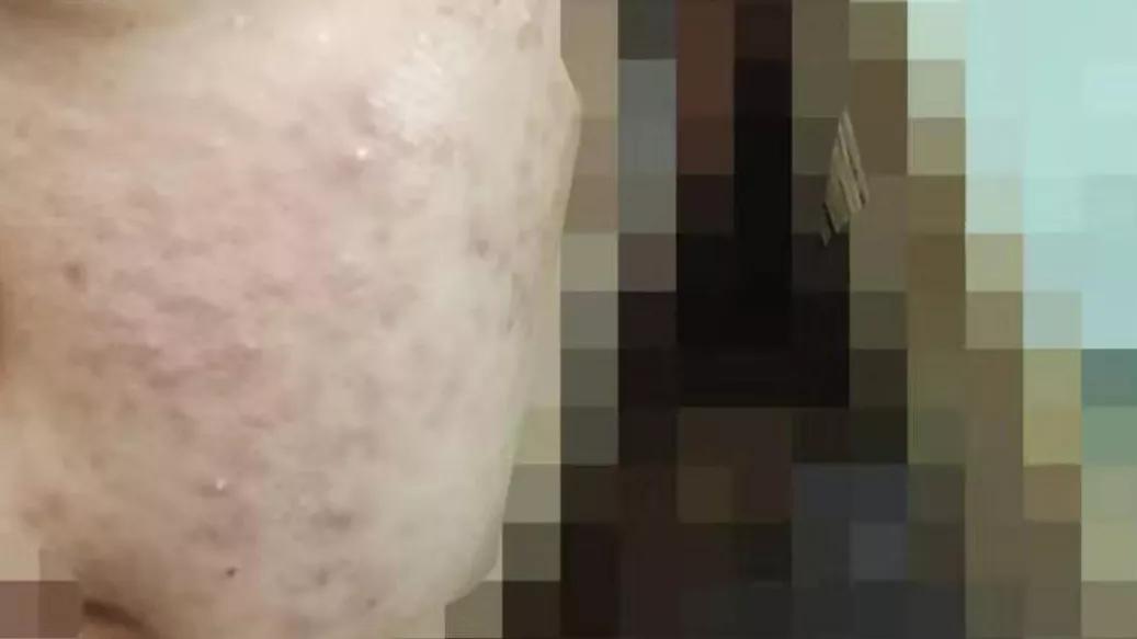 冻干祛痘面膜推荐,适合祛红痘印的面膜推荐