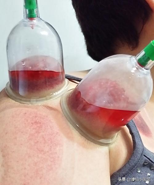 董氏奇穴肩周炎针灸一针见效,肩周炎扎针灸扎哪个部位教程