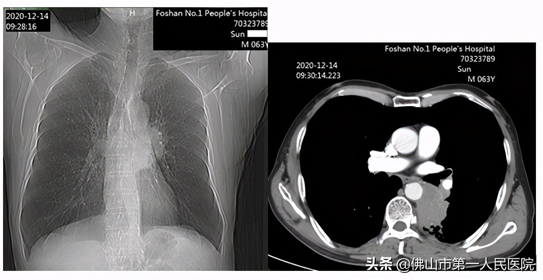 大爷得肺癌扩散被治好,七十岁老人肺癌晚期靶向治疗