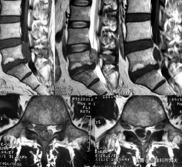 腰椎间盘突出最好的影像诊断方法,腰椎间盘突出的影像学检查