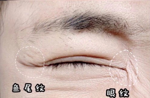 眼部细纹最好的方法,眼部细纹最有效的方法