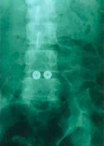 腰椎间盘突出症的临床诊治策略,腰椎间盘突出症的临床诊治